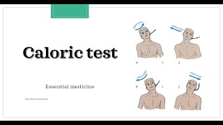 Caloric test Essential medicine [upl. by Vachel]