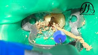 How To Remove GuttaPercha Easily During Root Canal Retreatment Cases  Easy GuttaPercha Removal [upl. by Isador516]