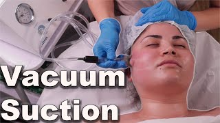 Vacuum suction facial treatment  avoid pore bruising step by step demo 2021 [upl. by Assilam]