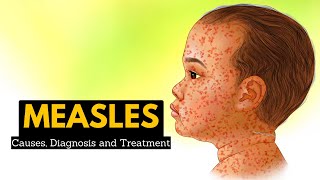 Measles Causes Signs and Symptoms Diagnosis and Treatment [upl. by Nneb13]