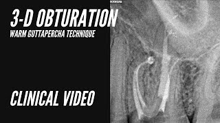 3D Obturation Warm guttapercha technique [upl. by Aloibaf]