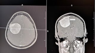 Brain Tumor Symptoms Described [upl. by Eidda]