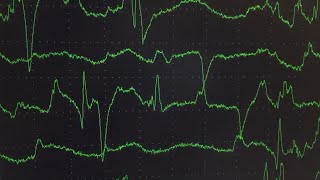 Electromyography EMG Findings in Progressive Encephalomyelitis With Rigidity and Myoclonus PERM [upl. by Eanaj]